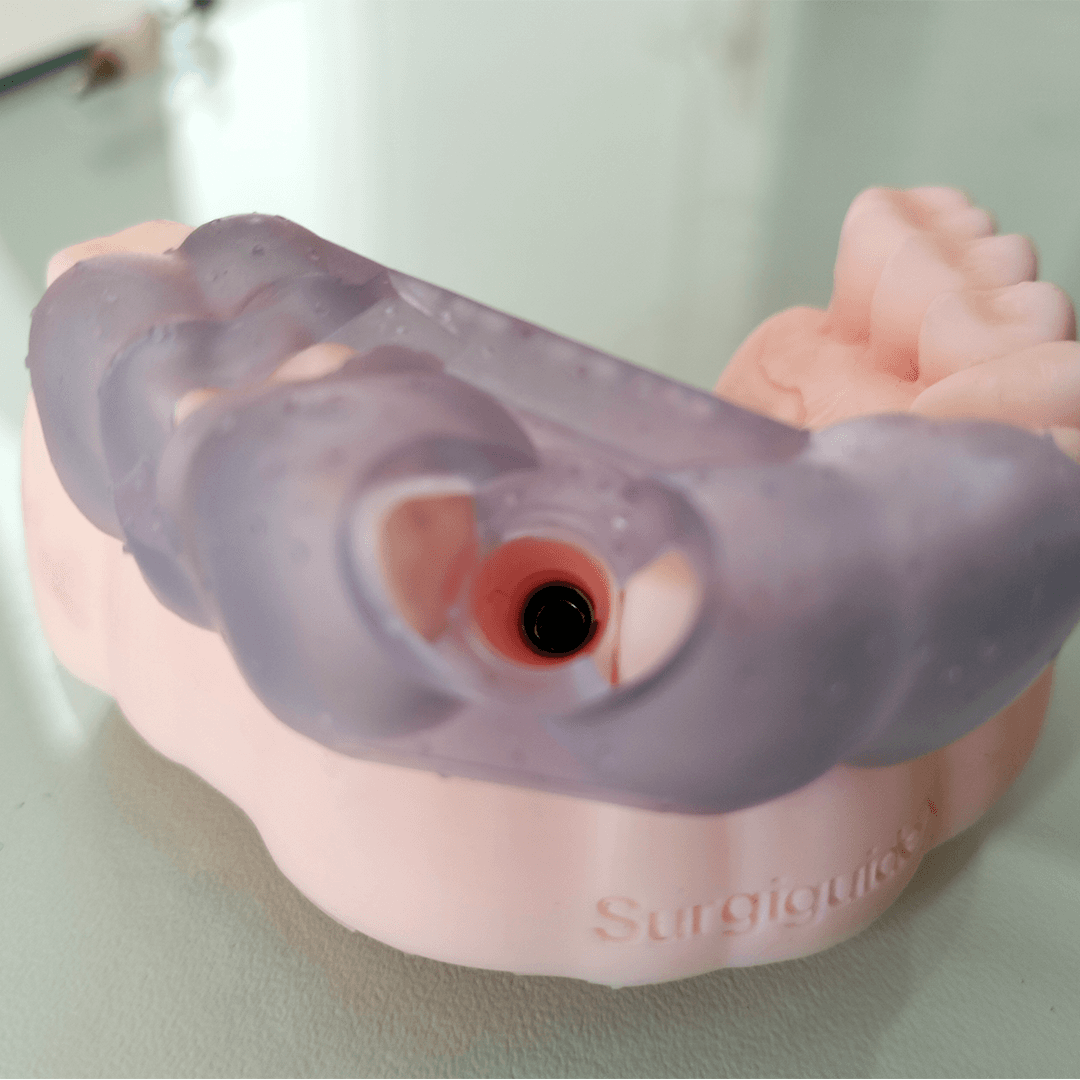 Tooth-supported guide