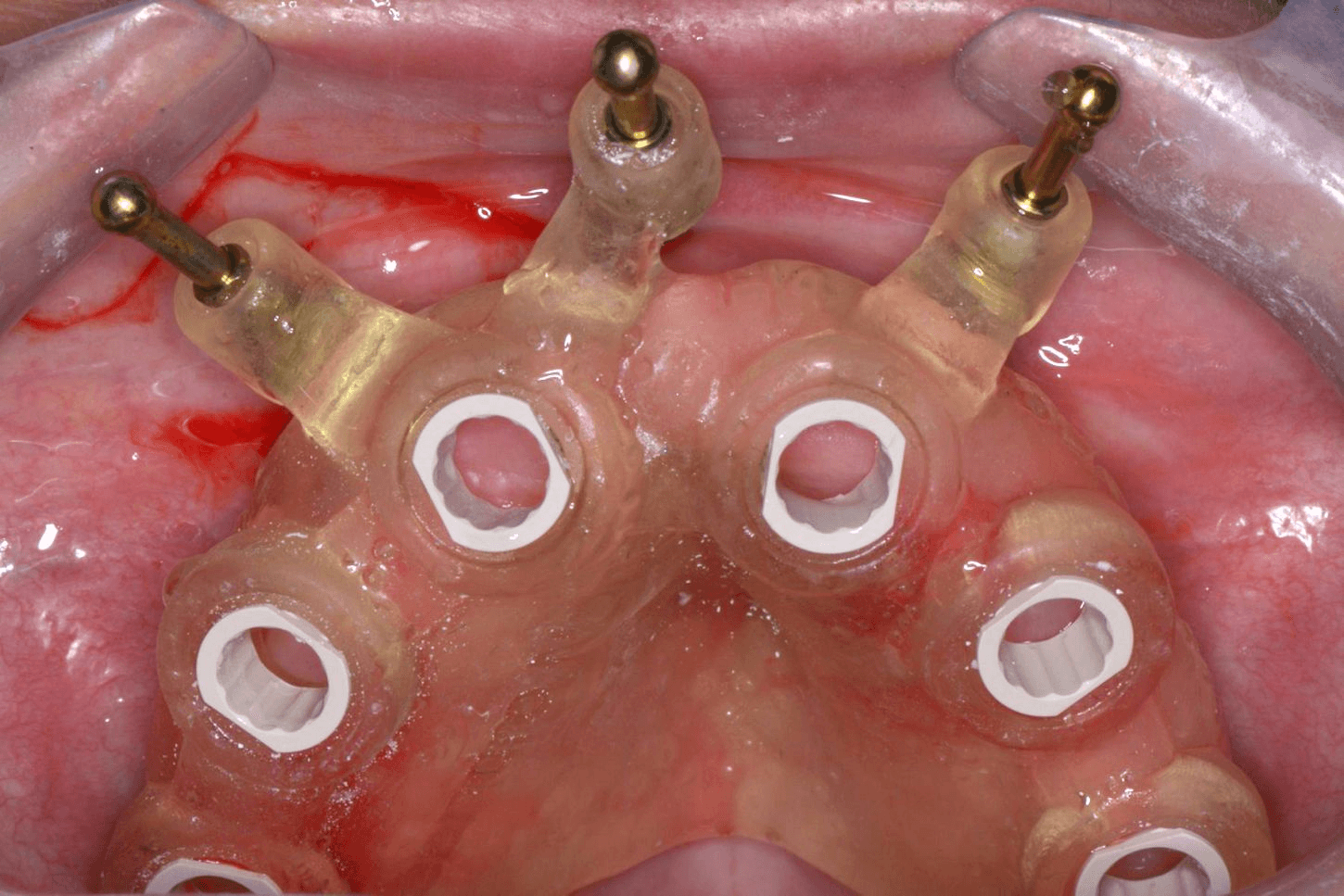 Tissue-supported guide